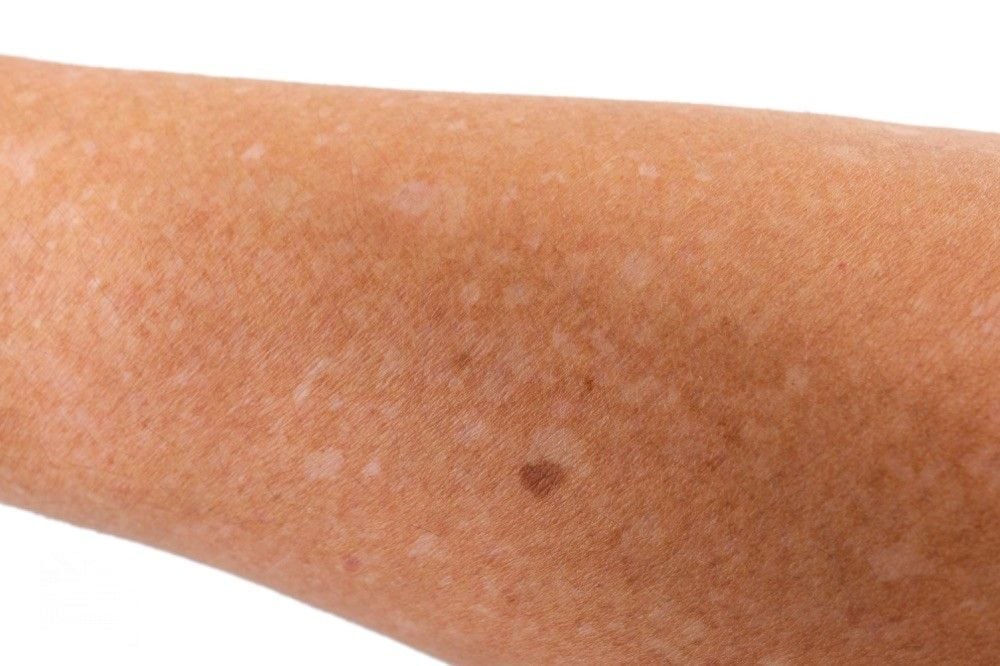 Pityriasis Versicolor Santé