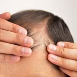Chute de cheveux masculine - Alopécie